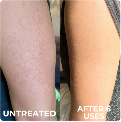 Advanced Triple-Acid Complex for Keratosis Pilaris