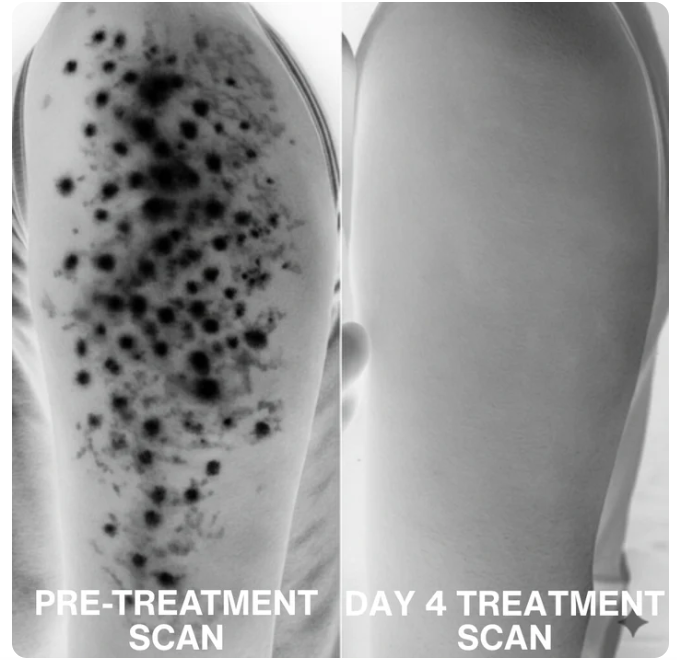 Advanced Triple-Acid Complex for Keratosis Pilaris