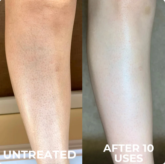 Advanced Triple-Acid Complex for Keratosis Pilaris